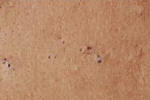 acne-blackhead-pimple.jpg