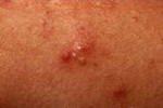 acne-whitehead-pimple.jpg
