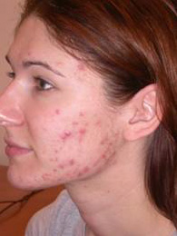 pre-treatmentacne.jpg